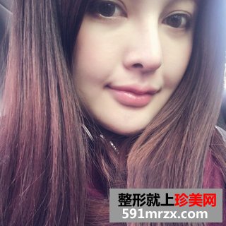 假体垫下巴恢复过程图 北京二炮假体垫下巴