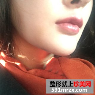 假体垫下巴恢复过程图 北京二炮假体垫下巴