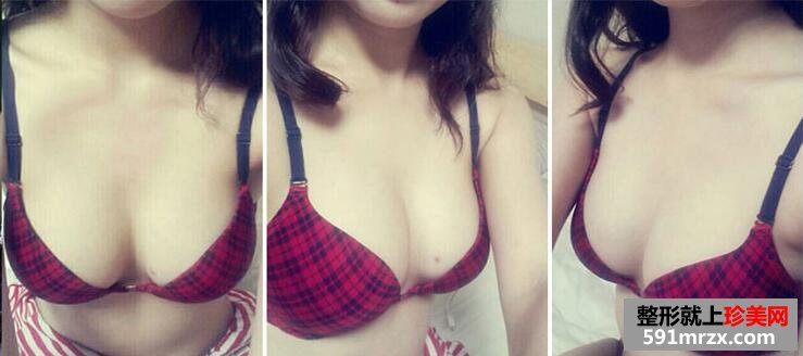 自体脂肪隆胸真实案例对比图