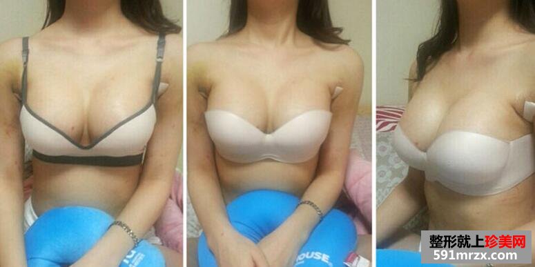 自体脂肪隆胸真实案例对比图