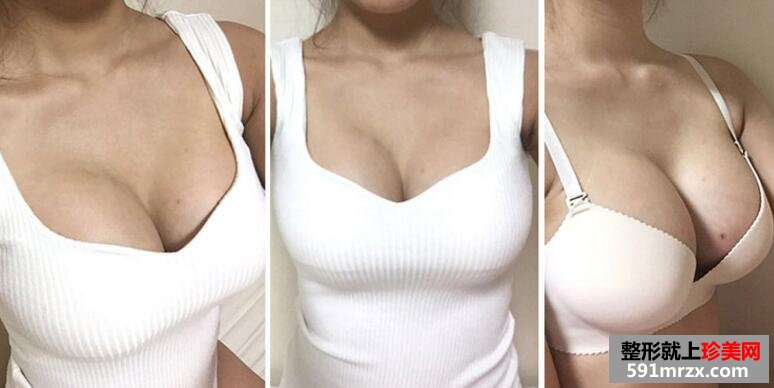 自体脂肪隆胸真实案例对比图