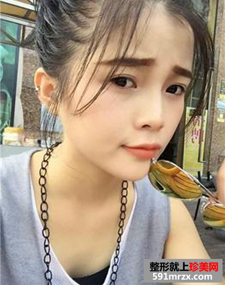 隆鼻手术真实案例对比图