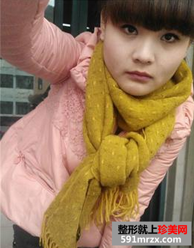 瘦脸针恢复真人案例对比图