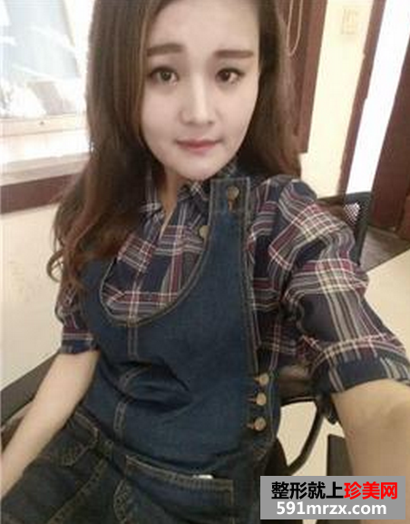 瘦脸针恢复真人案例对比图