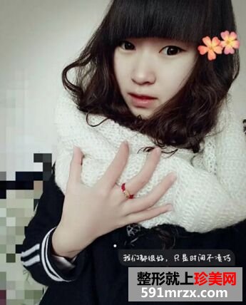全切扇形双眼皮恢复6个月很好看哟~
