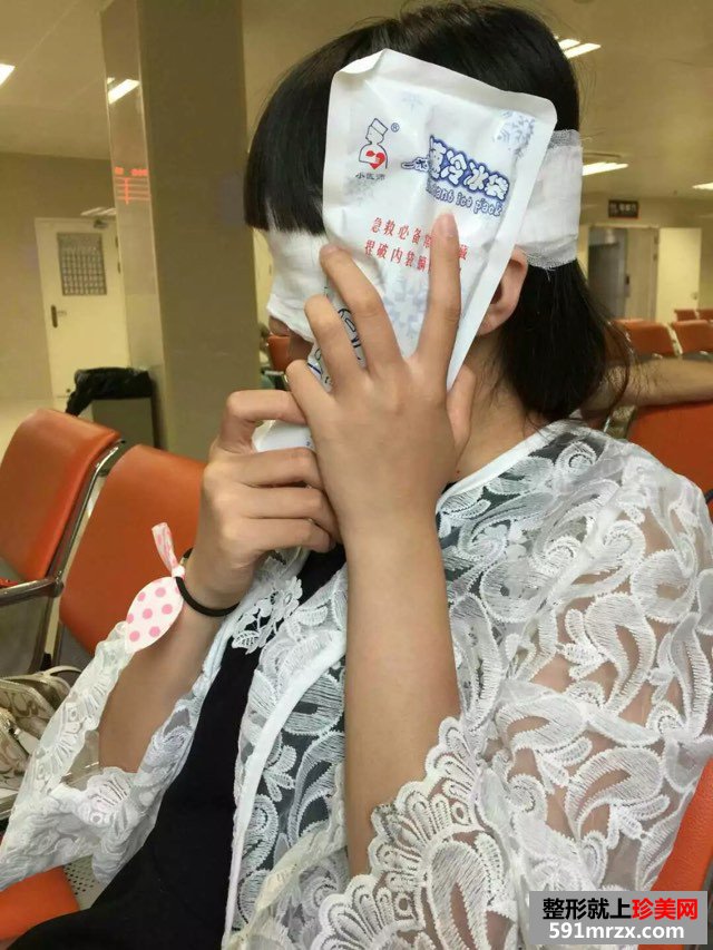 全切扇形双眼皮恢复6个月很好看哟~