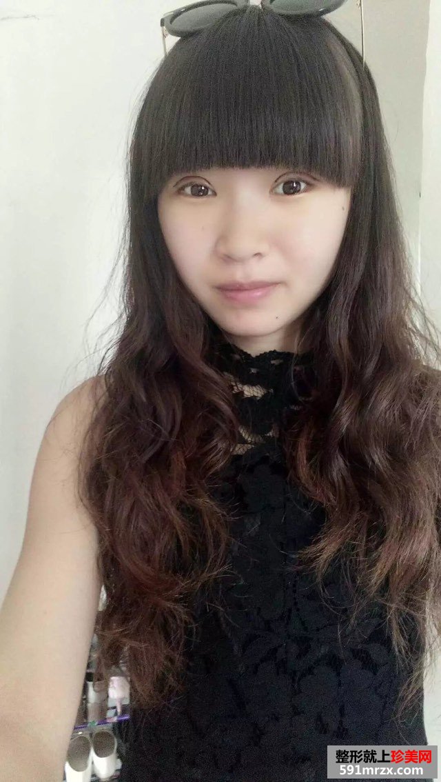 全切扇形双眼皮恢复6个月很好看哟~