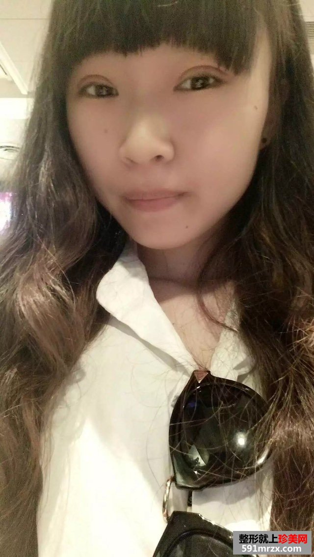 全切扇形双眼皮恢复6个月很好看哟~