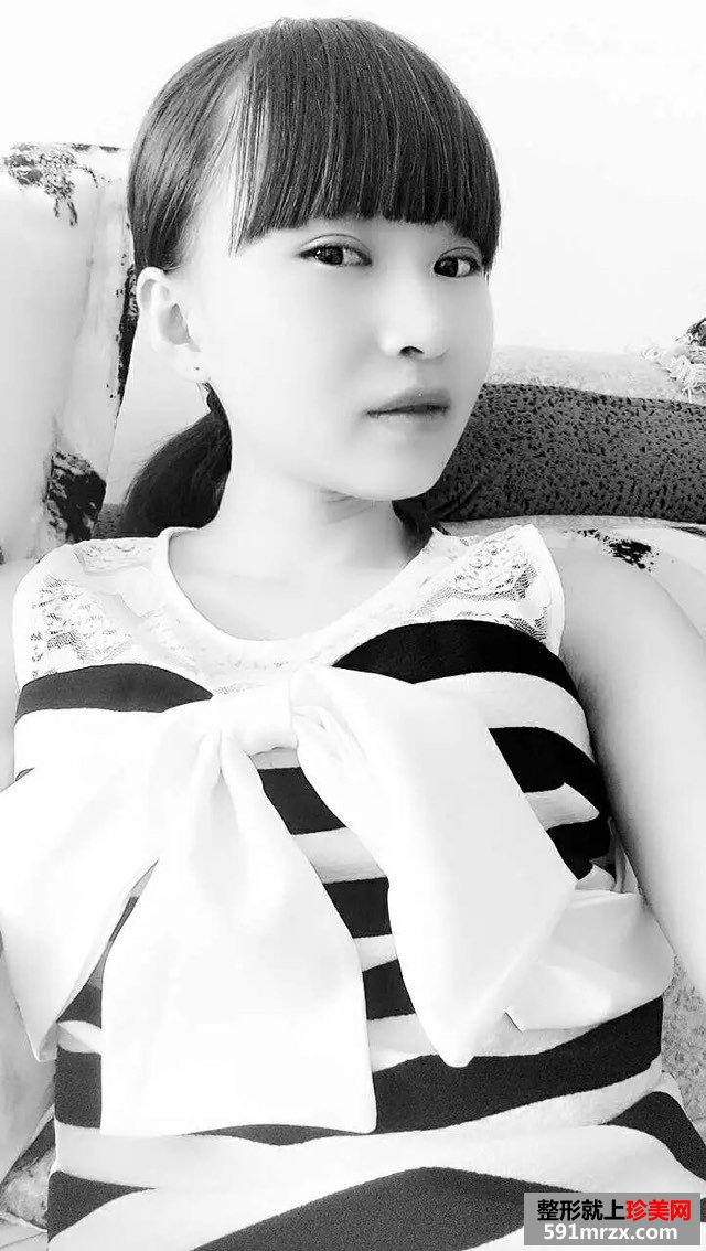 全切扇形双眼皮恢复6个月很好看哟~