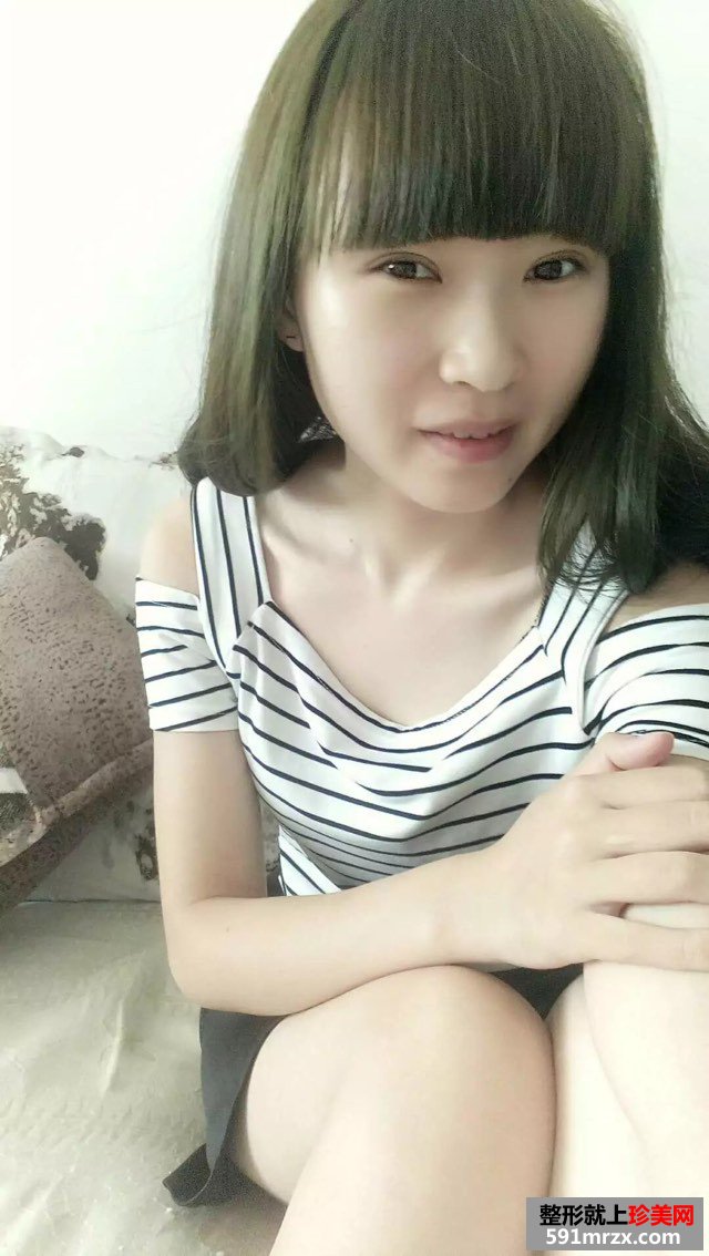 全切扇形双眼皮恢复6个月很好看哟~