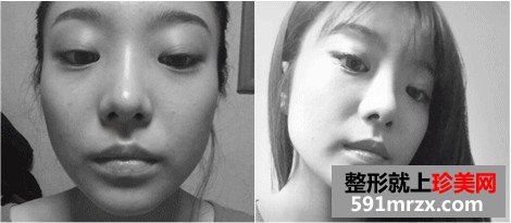 v-line下巴整形手术前后对比照和恢复过程案例分享
