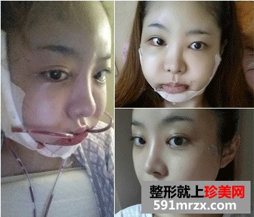 v-line下巴整形手术前后对比照和恢复过程案例分享