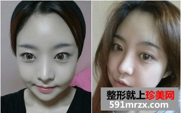 v-line下巴整形手术前后对比照和恢复过程案例分享