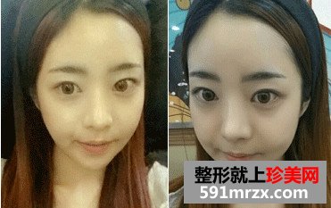 v-line下巴整形手术前后对比照和恢复过程案例分享