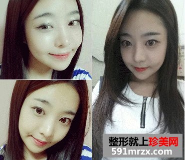 v-line下巴整形手术前后对比照和恢复过程案例分享