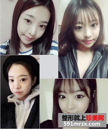v-line下巴整形手术前后对比照和恢复过程案例分享