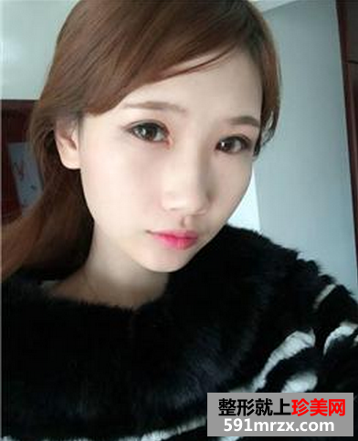 割双眼皮成功恢复案例对比图