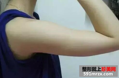 手臂吸脂后终于拥有纤细的胳膊