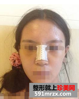 硅胶隆鼻+耳软骨垫鼻尖效果图分享