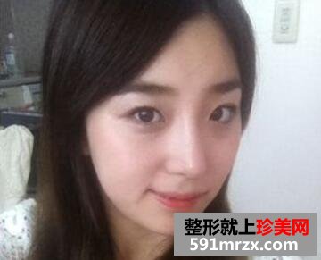 韩式生科三段假体隆鼻三个月恢复越来越好了