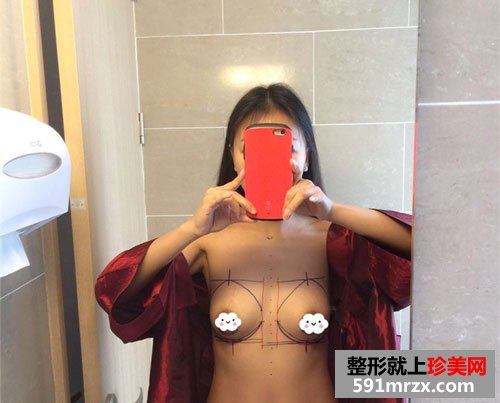 自体脂肪移植丰胸恢复过程和前后效果照片对比