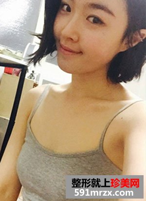 曼托水滴形假体隆胸术前后效果对比照和恢复过程分享