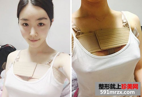 曼托水滴形假体隆胸术前后效果对比照和恢复过程分享