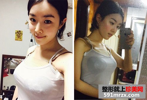 曼托水滴形假体隆胸术前后效果对比照和恢复过程分享