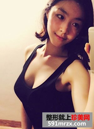 曼托水滴形假体隆胸术前后效果对比照和恢复过程分享