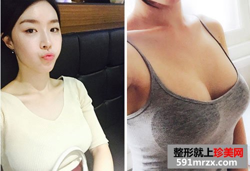曼托水滴形假体隆胸术前后效果对比照和恢复过程分享