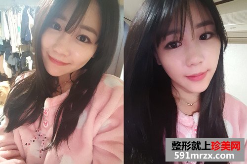 韩式超声刀+埋线面部提升恢复过程案例分享和前后对比照