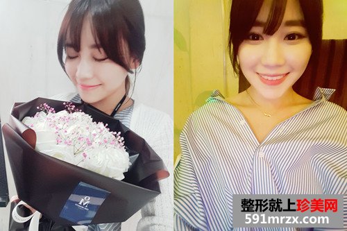 韩式超声刀+埋线面部提升恢复过程案例分享和前后对比照
