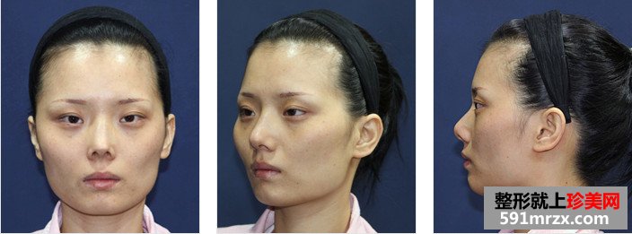 颧骨颧弓综合整形术前后效果真实案例图和恢复过程记录