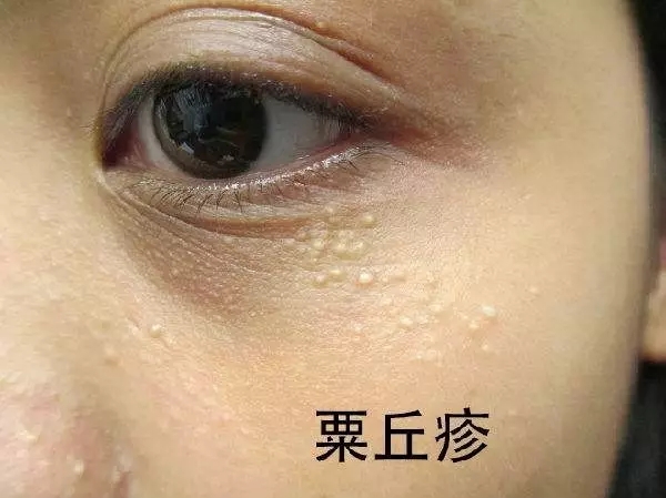 矫正驼峰鼻术后护理