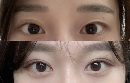 北京割双眼皮多少钱