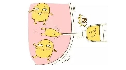 360度环形吸脂