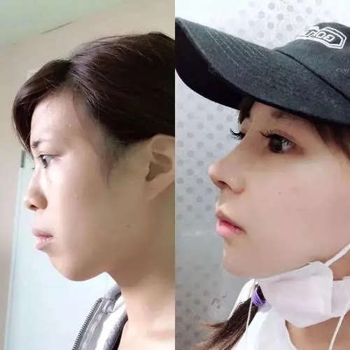 鼻部整形的价格