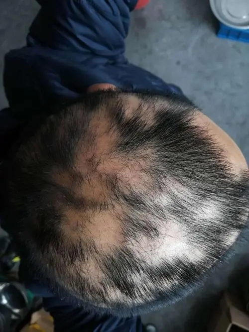 斑秃怎样治