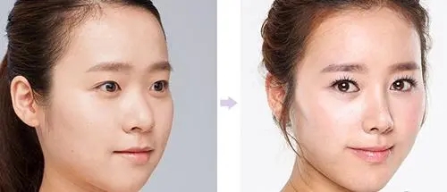 鼻头整形多少钱