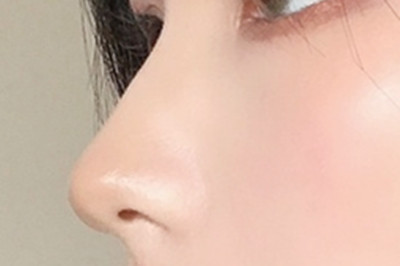 玻尿酸隆鼻手术价格