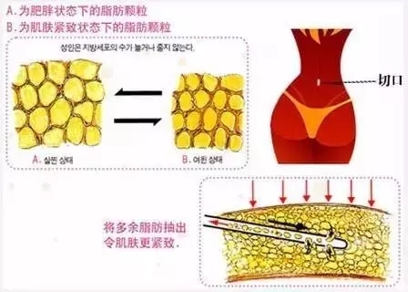 抽脂减肥要多少钱