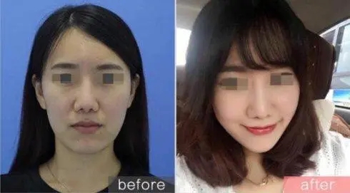 打玻尿酸隆鼻多少钱