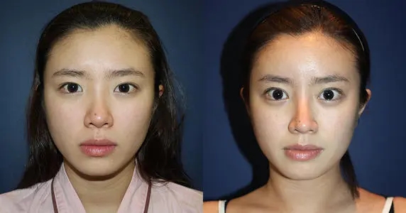 鼻尖美容整形手术