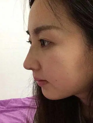 鼻尖整形手术-做个鼻尖手术多少钱