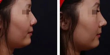 鼻孔缩小整形-鼻孔缩小整形常识