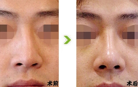 大鼻子整形一般多少钱