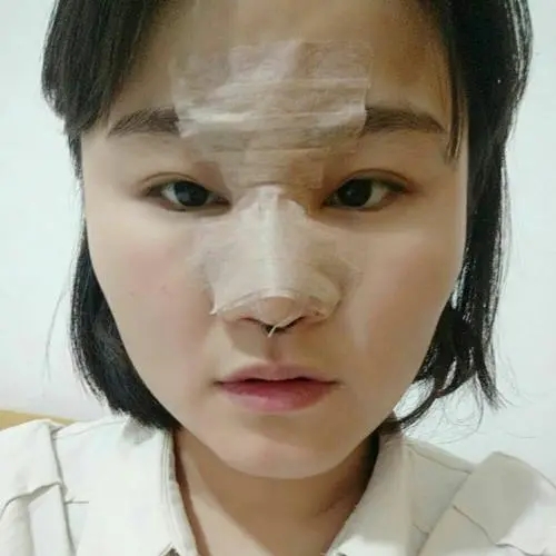 鼻中隔隆鼻手术