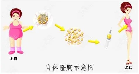 丰胸的价格