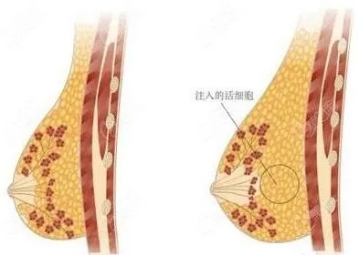 丰胸需要多少钱