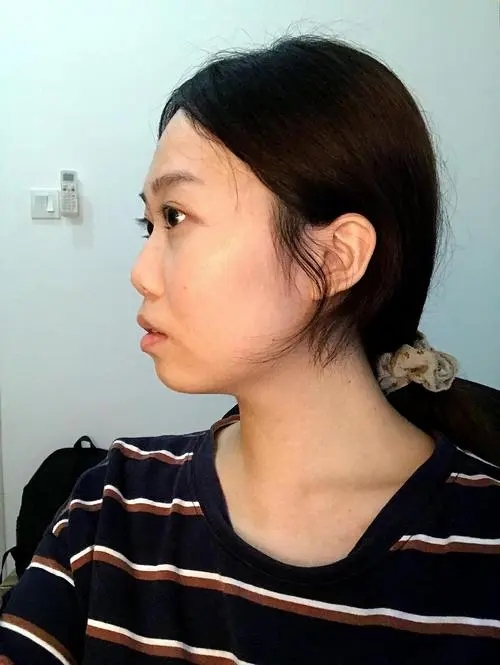 鼻子很塌怎么办